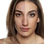 Tips to Get Rid of Acne