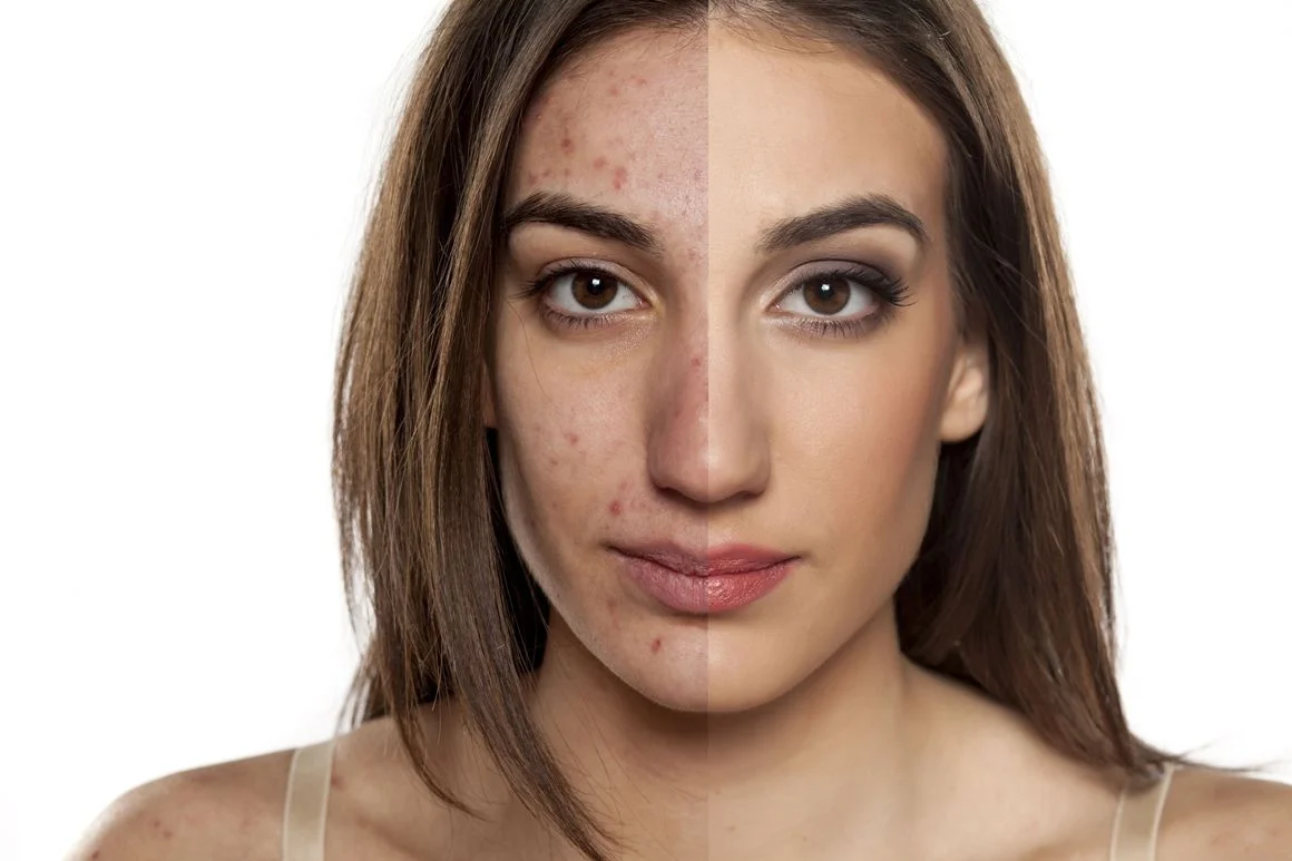 Tips to Get Rid of Acne