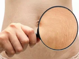 Stretch Marks1