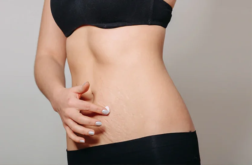 Stretch Marks3