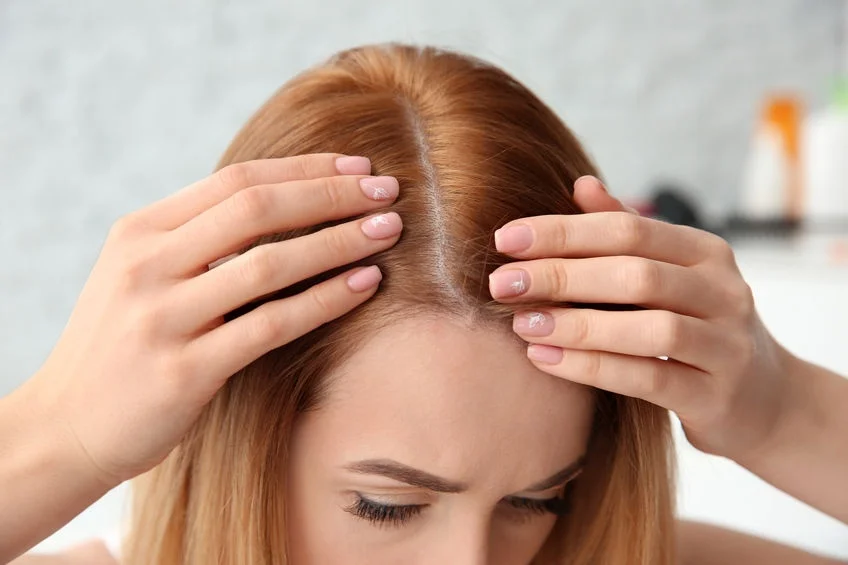 Hair Loss in Women1