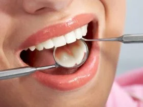Dental Fillings1