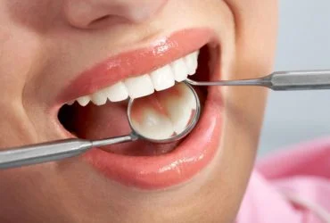 Dental Fillings1