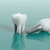 Dental Implants 2