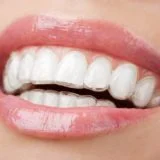 Invisalign 1