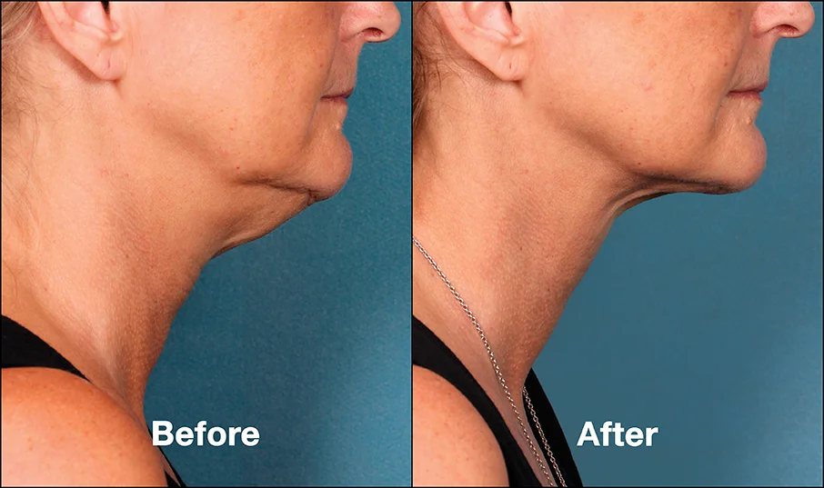 Neck Lift 1